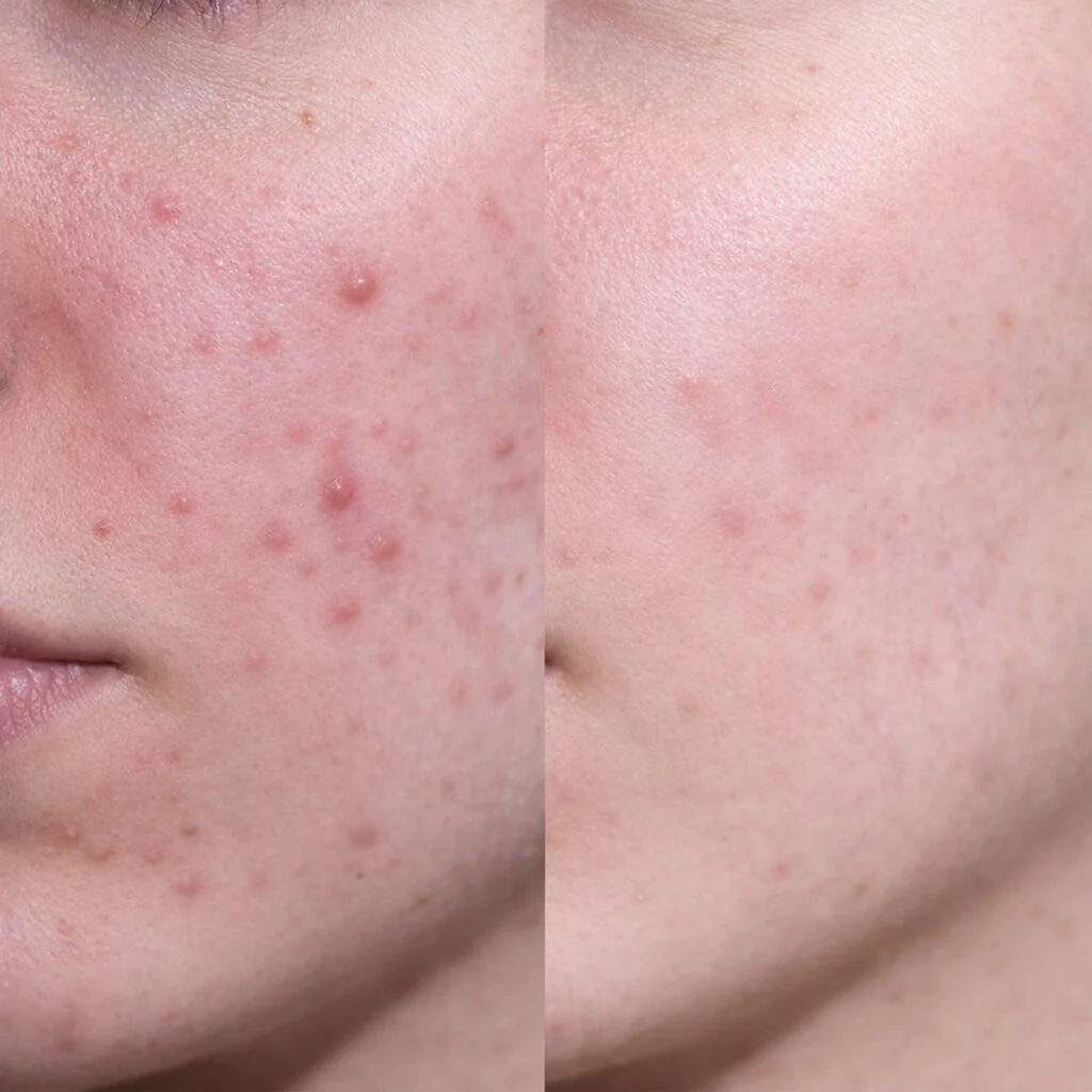 Gezichtscrème met salicylzuur tegen puistjes en mee-eters — Lichte, niet-vette moisturizer met salicylzuur voor een vette en onzuivere huid – reinigt poriën en vermindert talg. - Image 6