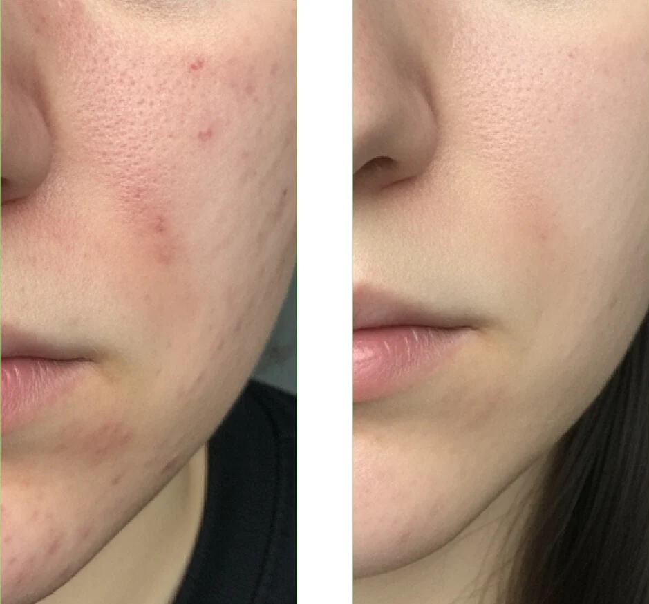 Salicylzuur Gezichtsreiniger tegen onzuiverheden — Salicylzuur Cleanser helpt tegen mee-eters, zuivert de huid en voorkomt verstopte poriën. Met Salicylzuur. - Image 6