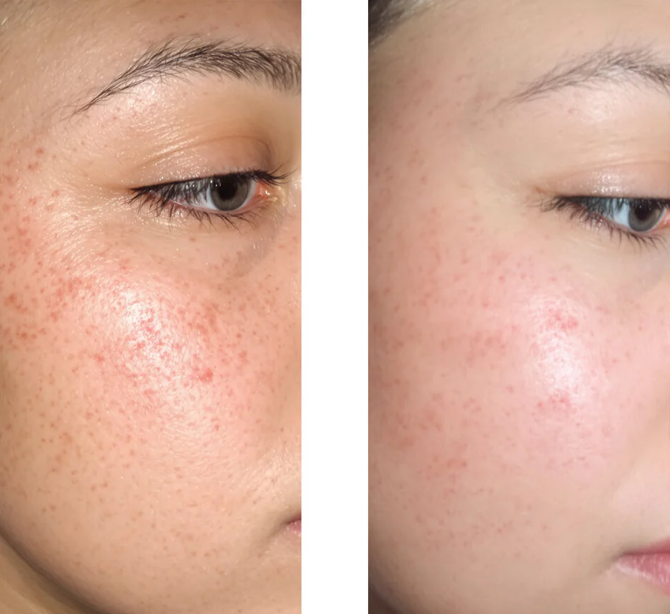 Salicylzuur serum voor mee-eters, vette huid en verstopte poriën — Salicylzuur serum bij vette huid, mee-eters en poriën. Met Zinc PCA, groene thee, hyaluronzuur en hydraterende glycerine. - Image 6