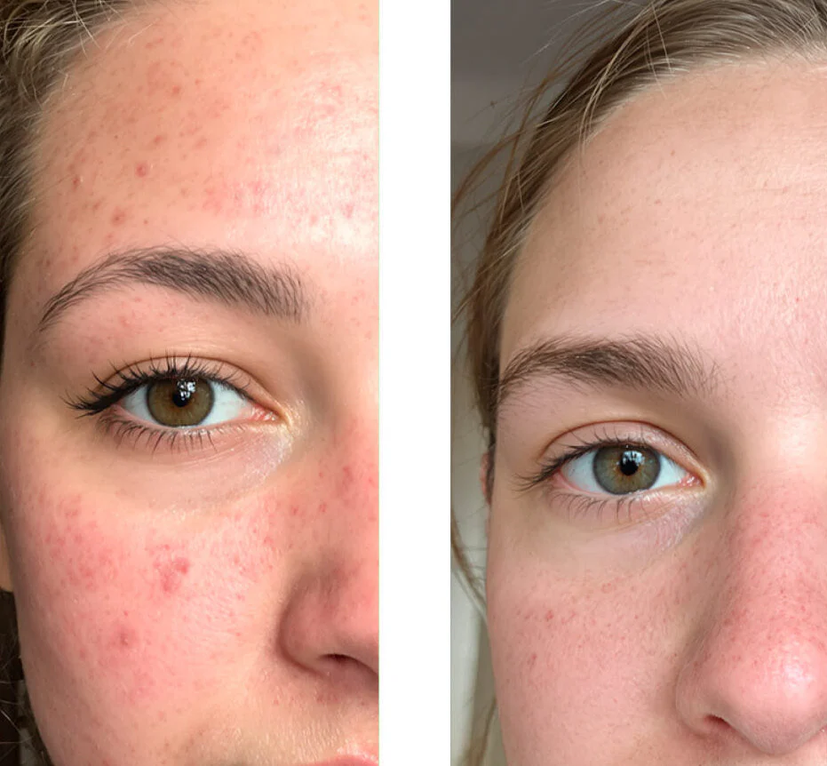 Salicylzuur-toner voor puistjes en vergrote poriën — Salicylzuur-exfoliant reinigt poriën, vermindert puistjes en verfijnt de huidstructuur. Perfect voor de dagelijkse verzorging. - Image 6